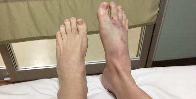 Opgezwollen rechter voet