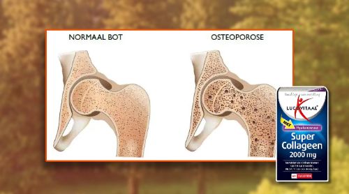 Foto van gezond bot en een foto van bot met osteoporose