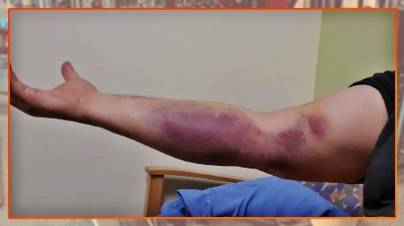 Paars en blauw gekleurde arm door gescheurde bicep