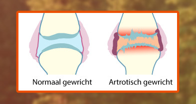 Tekening van een normaal gewricht en een gewricht met artrose